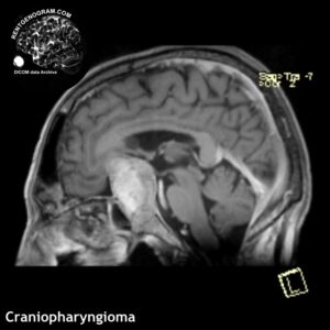 craniopharyngioma_head_mri_t1_sag_contrast