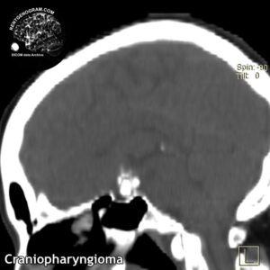 CF head MRI 5