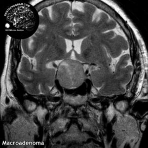 macroadenoma head MRI 1