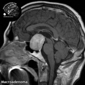macroadenoma head MRI 2