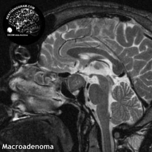 macroadenoma head MRI 13