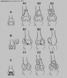 AO_ASIF_classification_knee_femur_fractures
