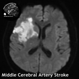 2.2 Middle cerebral artery stroke
