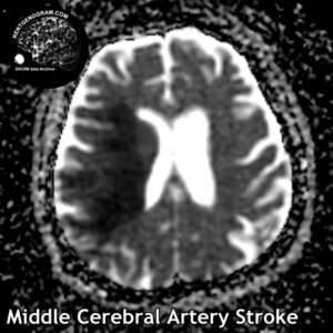 2.3 Middle cerebral artery stroke
