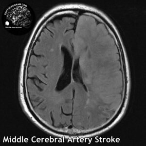 2.4 Middle cerebral artery stroke