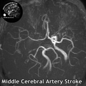 2.5 Middle cerebral artery stroke