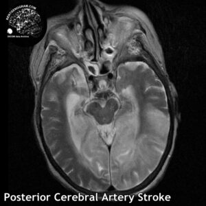 3.1 Posterior cerebral artery stroke