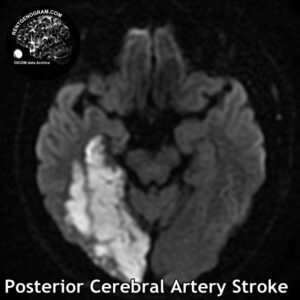 3.2 Posterior cerebral artery stroke