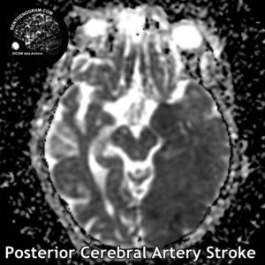 3.3 Posterior cerebral artery stroke