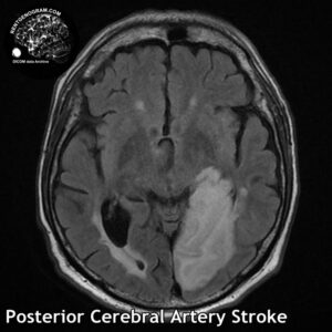3.4 Posterior cerebral artery stroke