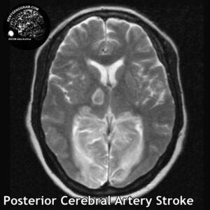 3.5 Posterior cerebral artery stroke