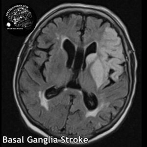 4.1 basal ganglia head MRI stroke 1