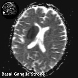 4.2 basal ganglia head MRI stroke 2