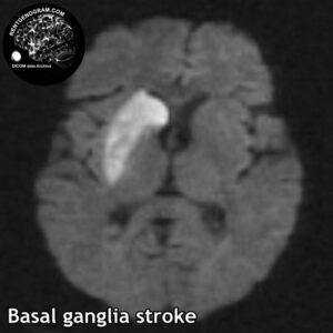 4.3 basal ganglia head MRI stroke 3