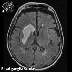 4.4 basal ganglia head MRI stroke 4