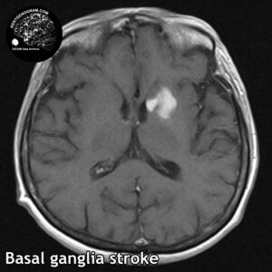 4.5 basal ganglia head MRI stroke 5