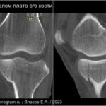 48_tibial_fracture_ct