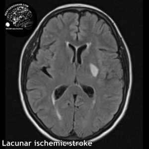 5.1 lacune stroke 1 head MRI