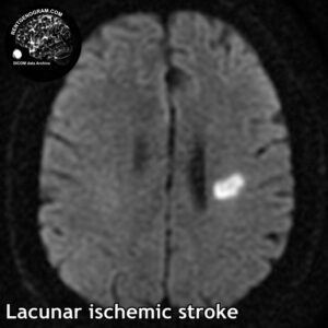 5.2 lacune stroke 2 head MRI