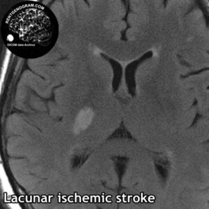 5.3 lacune stroke 3 head MRI