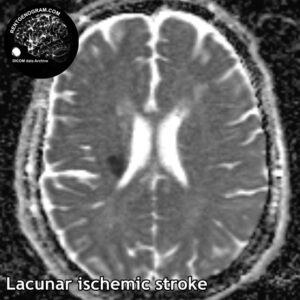 5.4 lacune stroke 4 head MRI