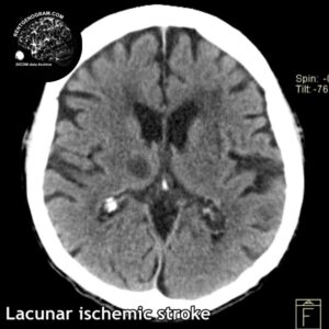 5.5 lacune stroke 5 head CT