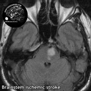 6.1 stem stroke 1 head MRI