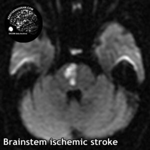 stem stroke 2 head MRI