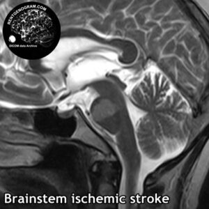6.3 stem stroke 3 head MRI