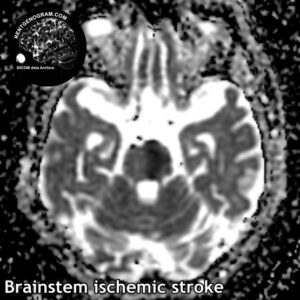 6.4 stem stroke 4 head MRI