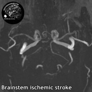 6.5 stem stroke 5 head MRI