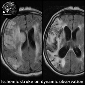 7.1-dynamic analys stroke MRI 1