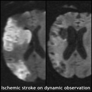 7.2-dynamic analys stroke MRI 2