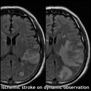 7.3-dynamic analys stroke MRI 3