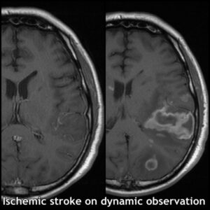 7.4-dynamic analys stroke MRI 4