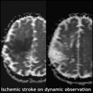 7.5-dynamic analys stroke MRI 5