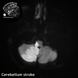 cerebellum_stroke_mri_dwi_tra