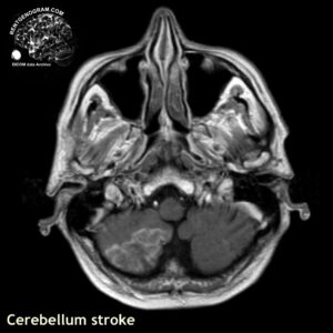 cerebellum_stroke_mri_t1_tra_contra