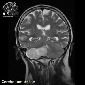 cerebellum_stroke_mri_t2_cor
