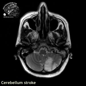 cerebellum_stroke_mri_t2_tra