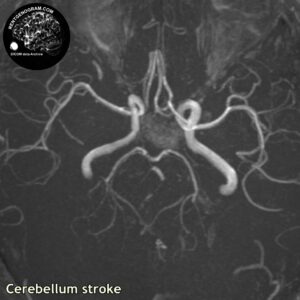 cerebellum_stroke_mri_tof_tra