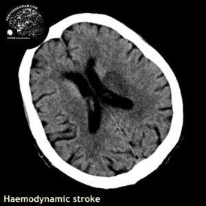 hemodynamic_stroke_ct_tra
