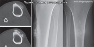 periostal_osteosarcoma_x-ray_&_ct