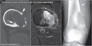 teleangioectatic_osteosarcoma_x-ray_&_ct