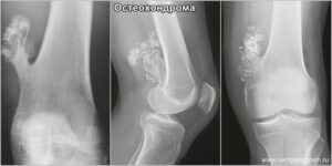 osteochondroma_x-ray
