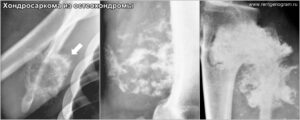 chondrosarcoma__from_osteochondroma_x-ray