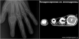 chondrosarcoma_from_enchondroma_ct_mri_x-ray