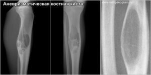 aneurismatic_bone_cyst_x-ray