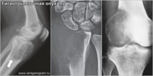 giant_cell_tumor_x-ray_mri