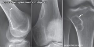 non_ossificans_fibroma_x-ray